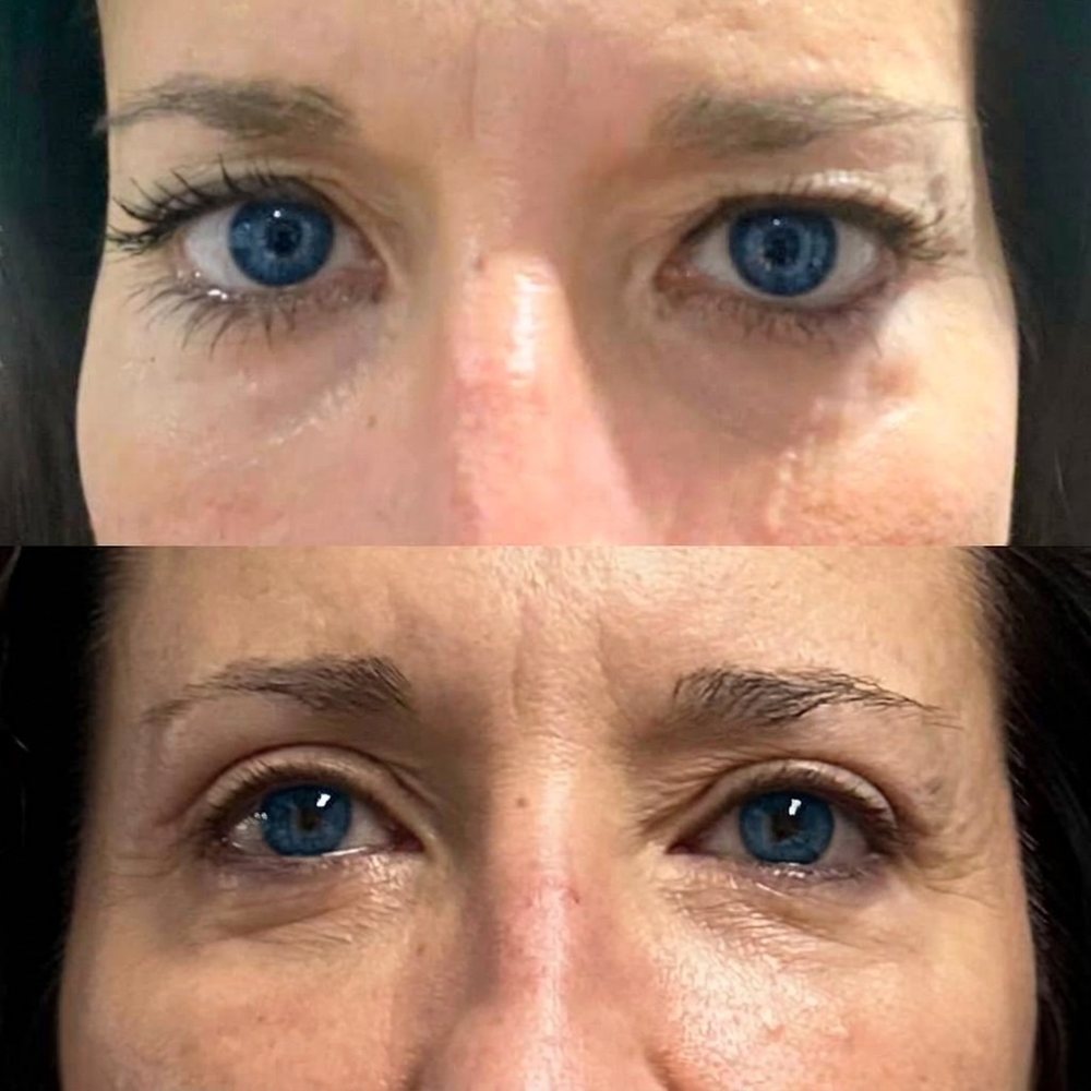 Blefaroplastia: antes (arriba) y después (abajo)