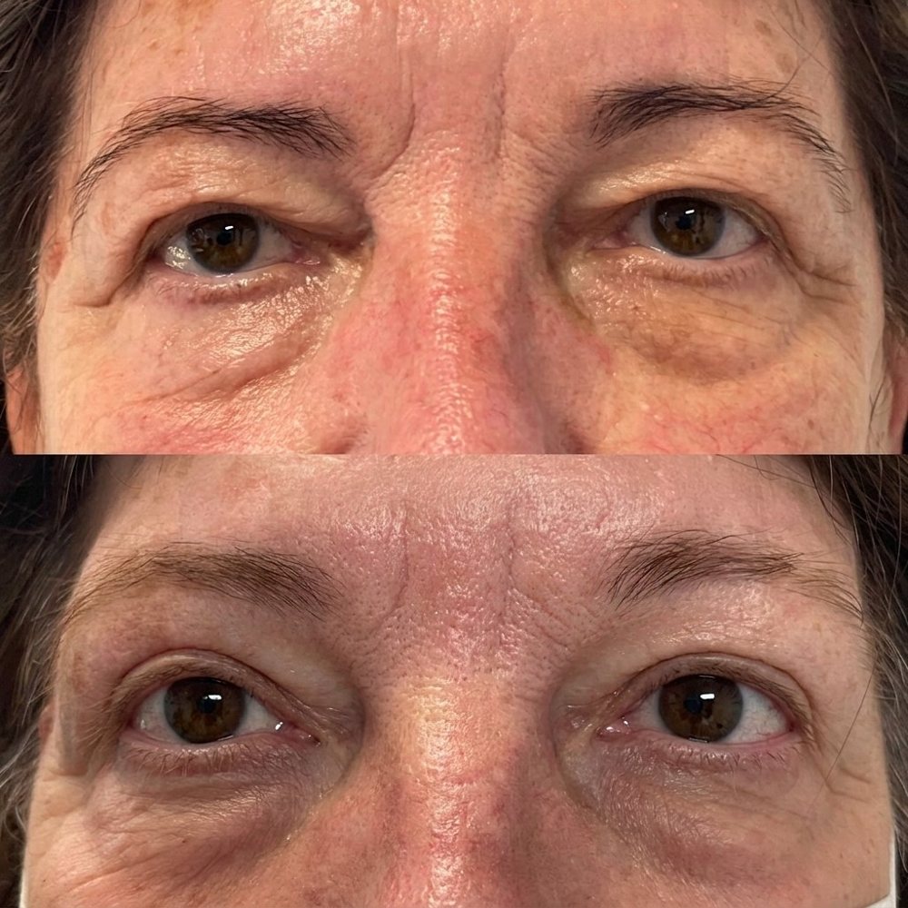 Blefaroplastia: antes (arriba) y después (abajo)