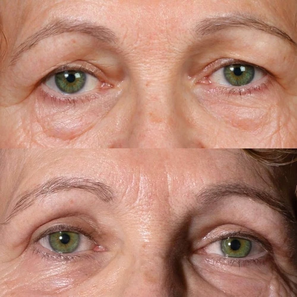 Blefaroplastia: antes (arriba) y después (abajo)