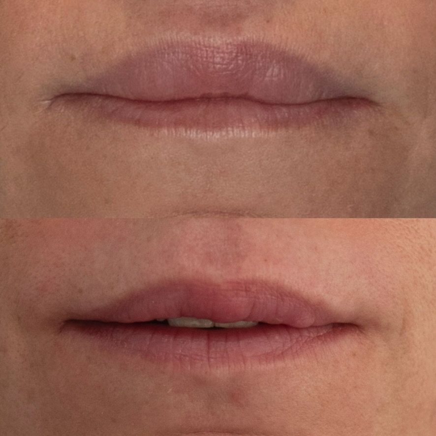 Retirada de material permanente en labios: antes (arriba) y después (abajo)
