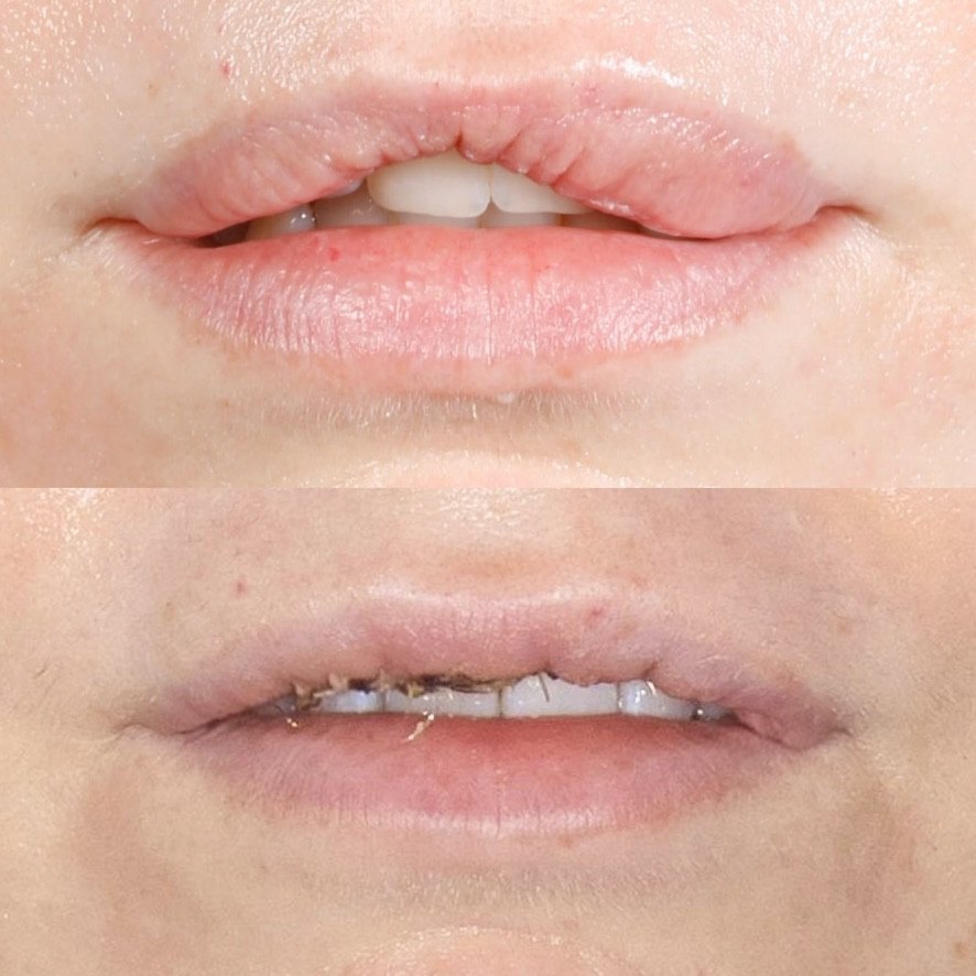 Cirugía de labio superior: antes (arriba) y postoperatorio inmediato, con los puntos (abajo)