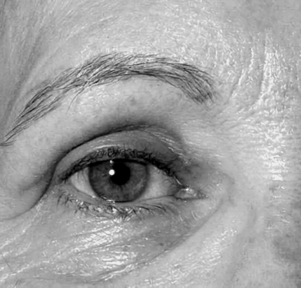 Mirada natural tras una blefaroplastia, Dra. Mar Gonzálvez en Alicante
