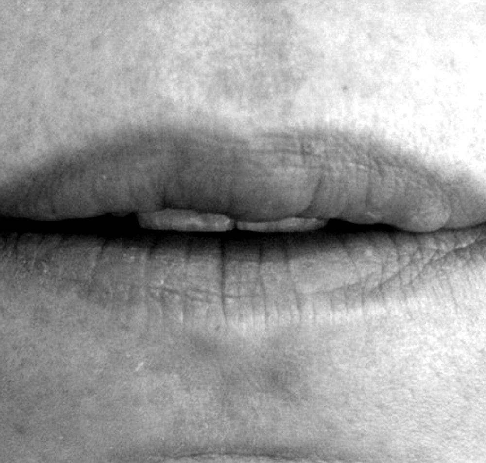 Labios naturales tras la retirada de silicona en Alicante